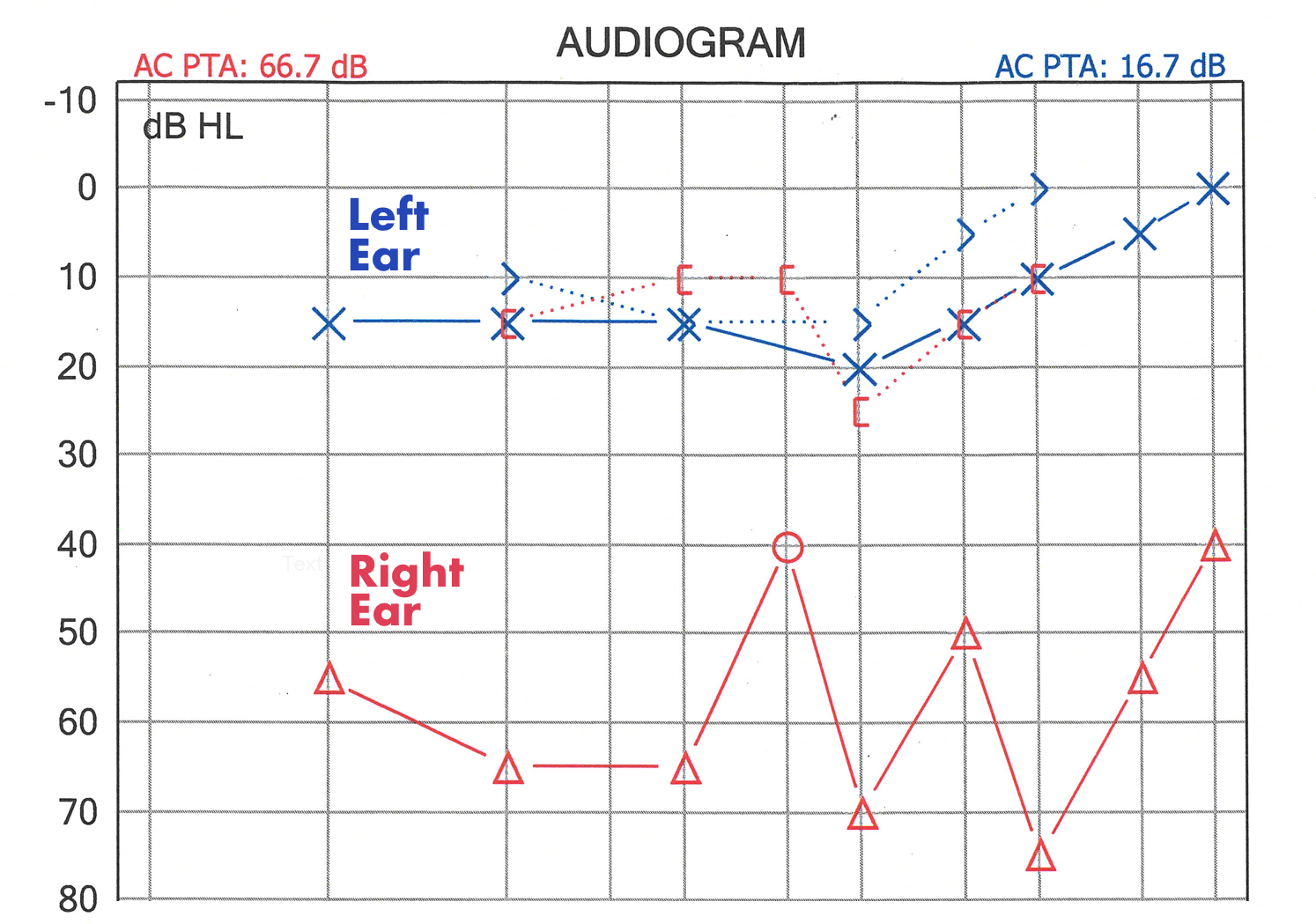 Results of audiology test