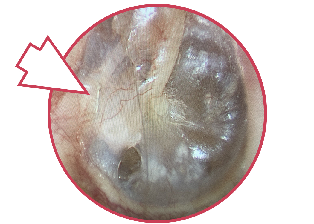 Image of my eardrum with wire visible